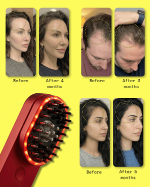 Nova 5-in-1 Scalp Rejuvenation System